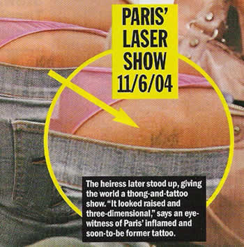 Paris Hilton Tattoo Removal
